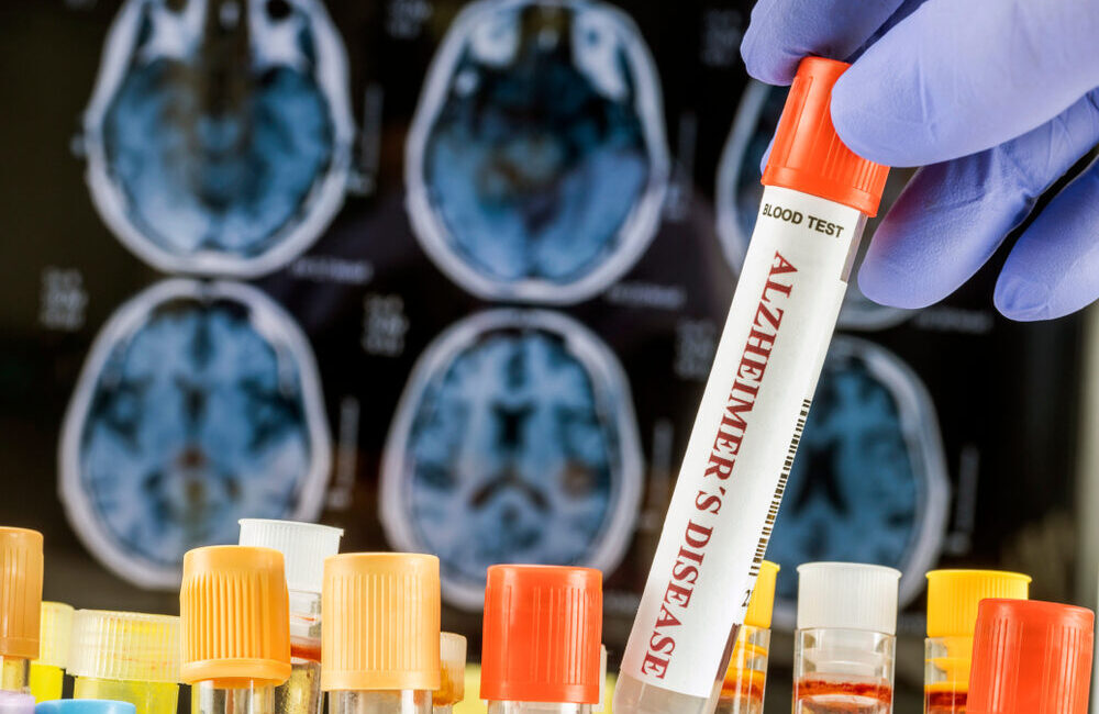 Organoidi cerebrali per la ricerca sull'Alzheimer